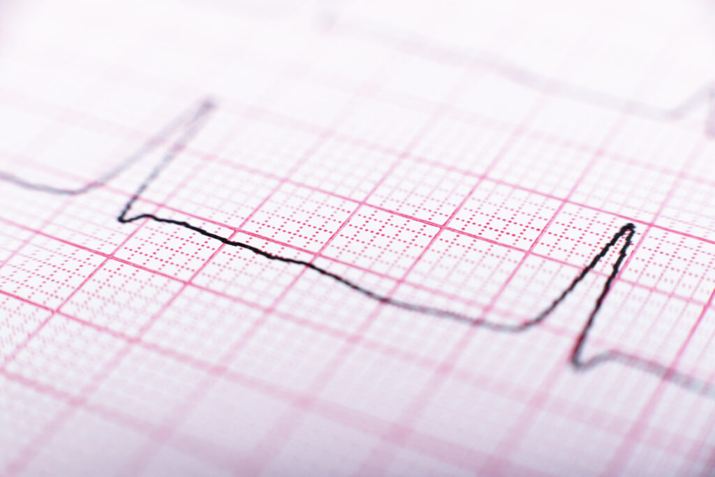 how does ecg interpretation work?
