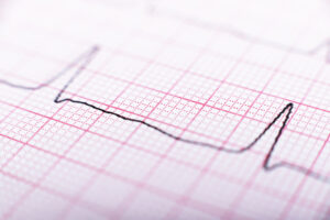 how does ecg interpretation work?