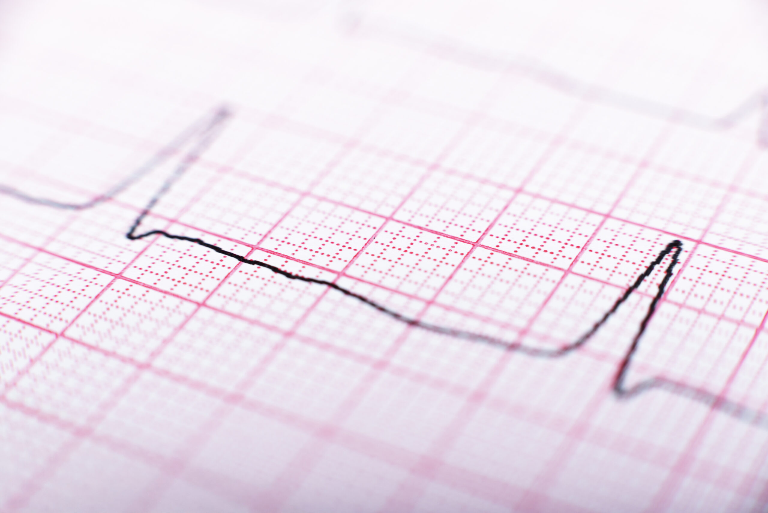 how does ecg interpretation work?